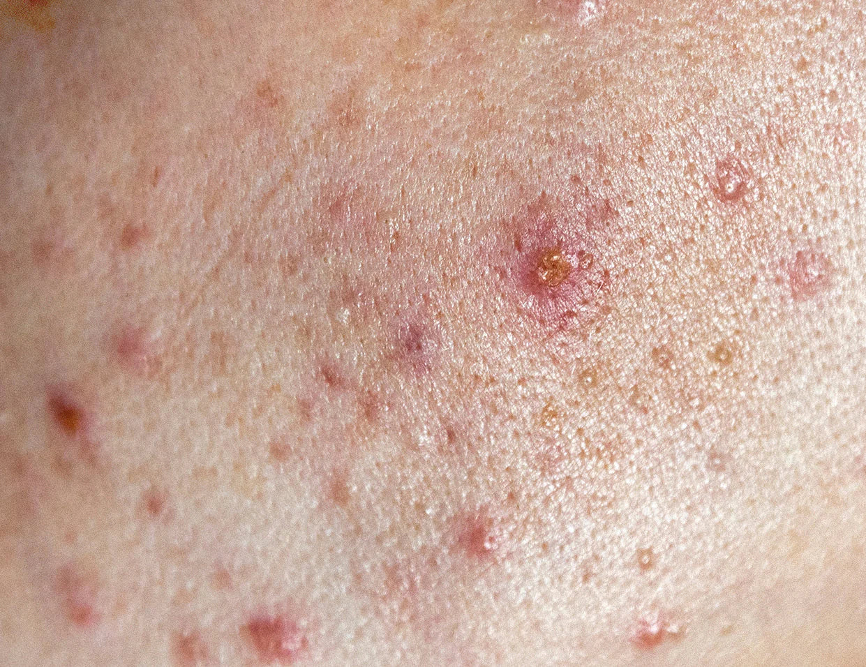 Acne Prone