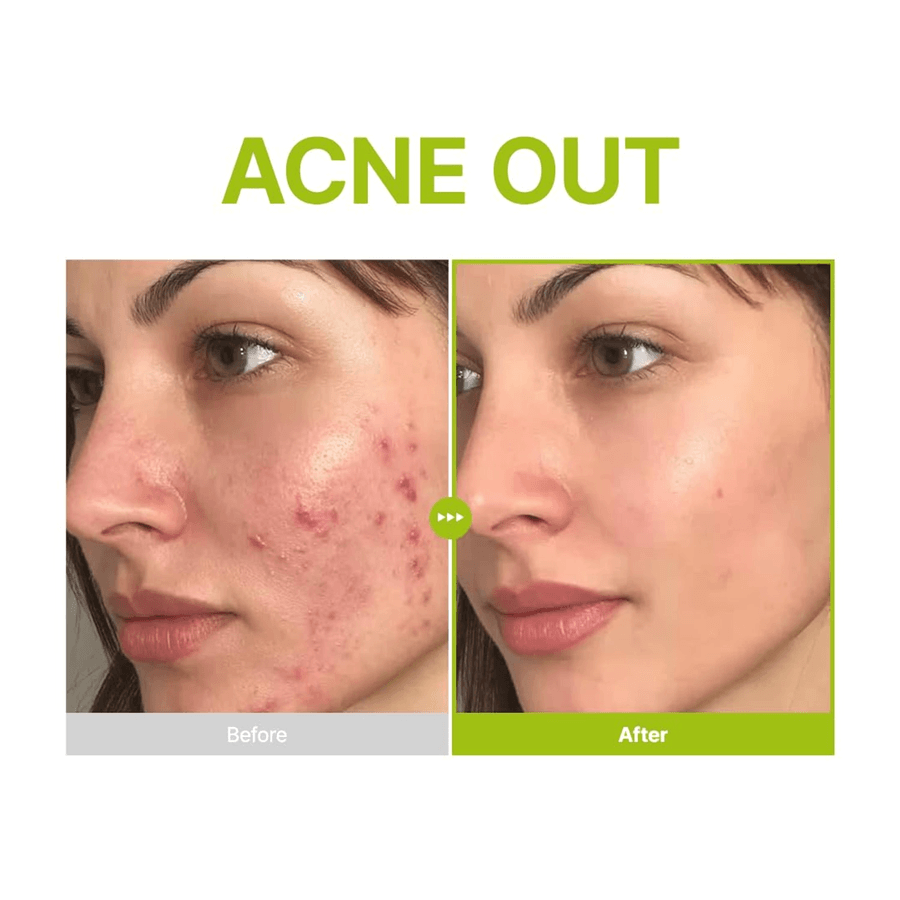 Azelaic Acid 10 Kojic Azulene Serum 30ml